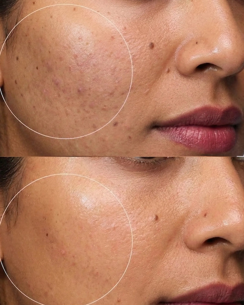 Anti Acne Gel