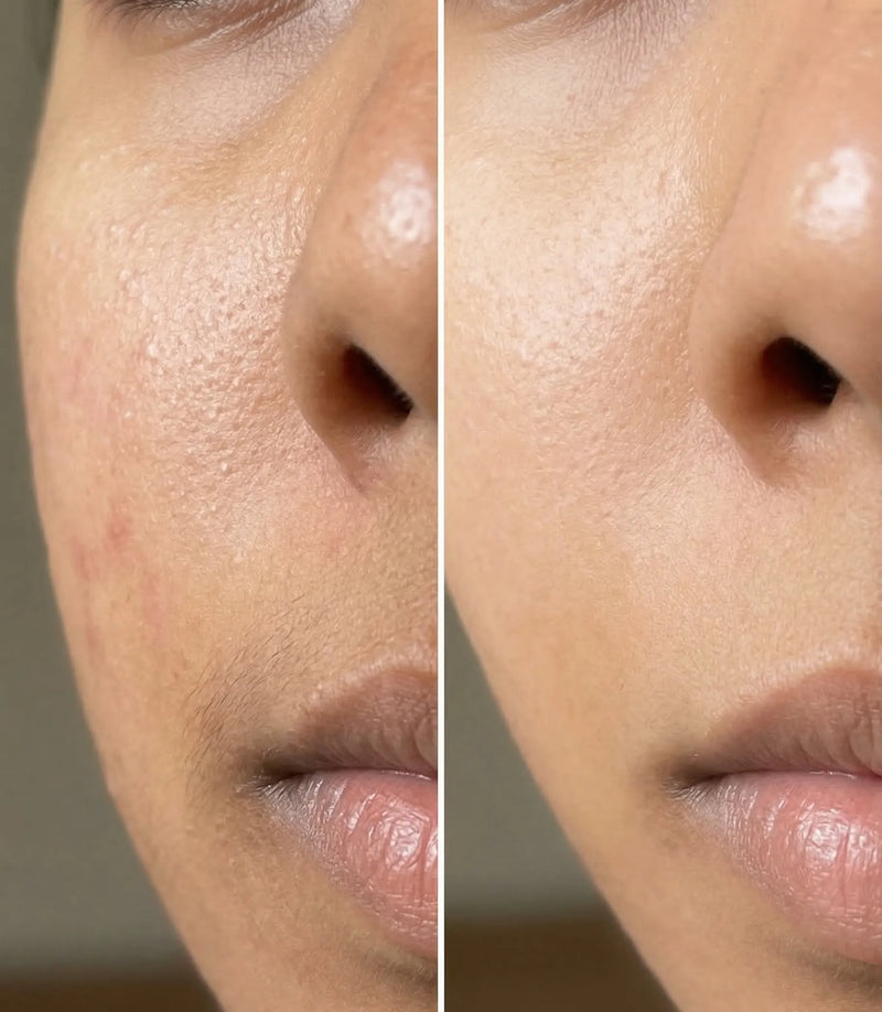 Hyperpigmentation Serum